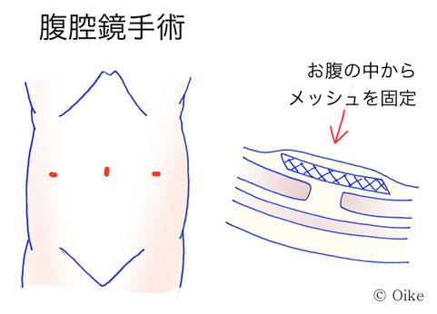 そけいヘルニアについて4
