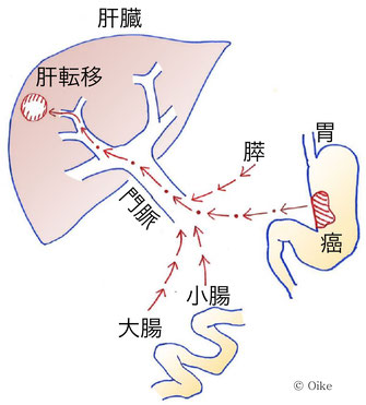 肝転移
