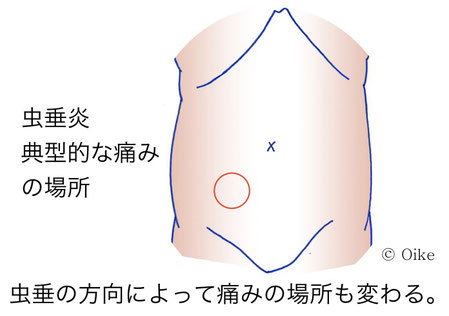 虫垂炎について03