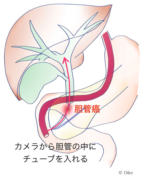 胆管癌について04