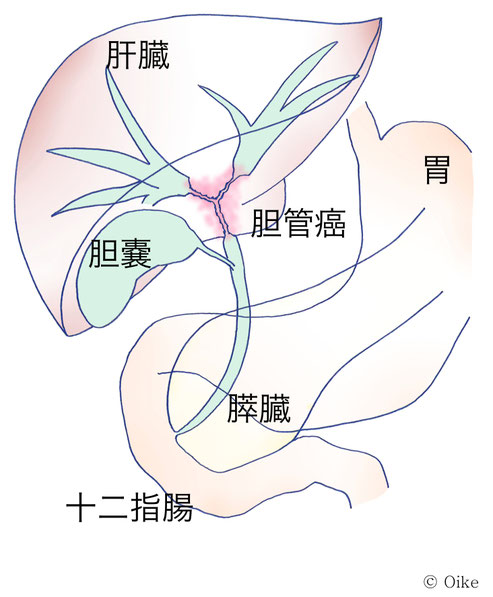 胆管癌について07