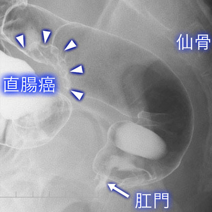 大腸癌について04