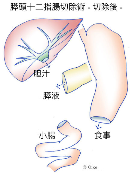 膵癌について02