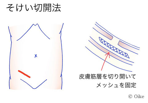 そけいヘルニアについて3