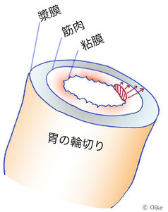 深達度が粘膜止まりの場合