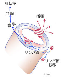 転移を起こす可能性がある進行胃癌