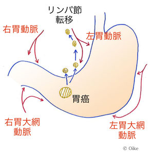 癌細胞がリンパ管に入ると