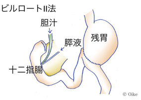 ビルロートII法